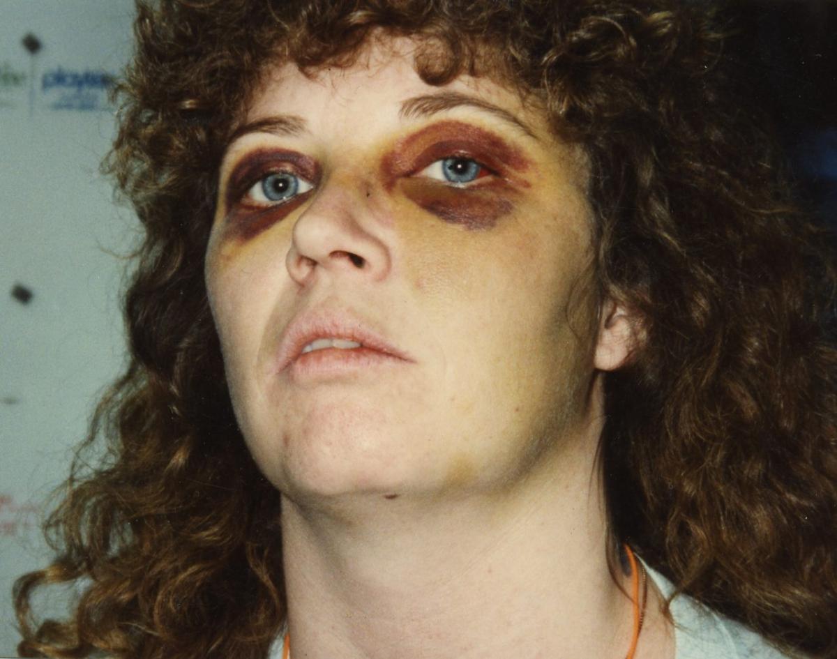 Woman with bruised eyes